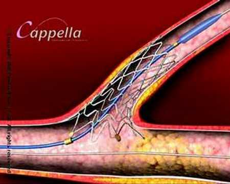 Cardiology heart valve stent, 3 D medical animation produced by Virtual