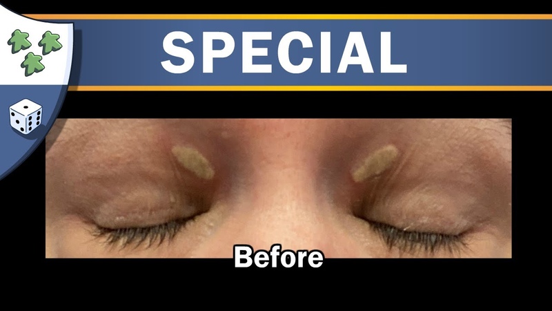 Ryan did a thing. Episode 3: Self Surgery ( Xanthelasma removal with Wartner