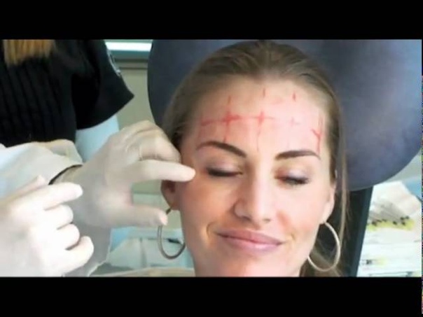 BOTOX BEFORE AFTER Beautiful South Beach Model
